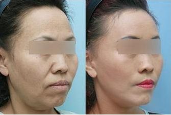 杭州吸脂手術哪家醫(yī)院可靠