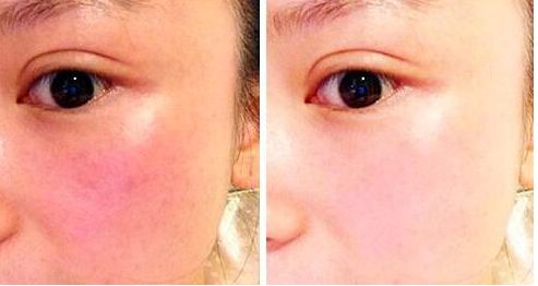 東莞鼻整形專家薈萃！治療頑固鼻部問(wèn)題有招！