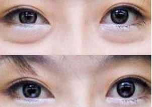 朝陽區(qū)雙眼皮手術(shù)就找TA！專家力推朝陽二醫(yī)院頂級(jí)雙眼皮醫(yī)生