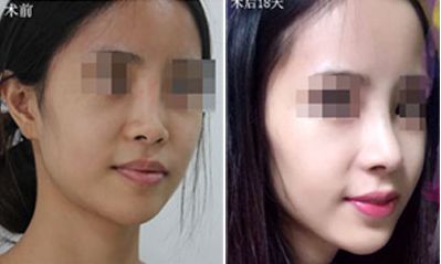 深圳哪家醫(yī)院隆胸效果好？排名前五火熱推薦！