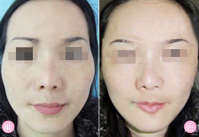 十堰黃褐斑治療哪里專業(yè)？好去哪家醫(yī)院問一問