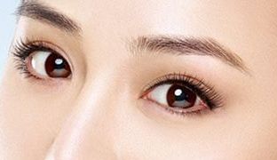 成都米蘭柏羽雙眼皮曝光！醫(yī)生做雙眼皮風(fēng)格如何？對比照片供參考