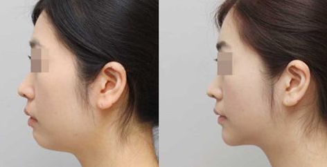 長(zhǎng)春哪家醫(yī)院治療肋骨鼻效果好，推薦這些知名醫(yī)院