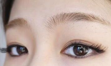 上海尚麗格杜園園做雙眼皮的可行性分析及案例回顧