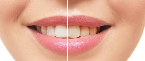 上海亞太整形醫(yī)院2023年隆鼻案例發(fā)布，廣受好評！