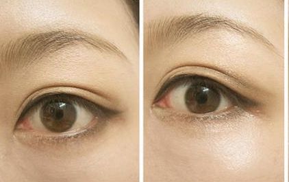 沈燕華醫(yī)生雙眼皮技術(shù)值得信賴，術(shù)后效果受到患者一致好評(píng)！