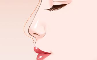 臨沂市人民醫(yī)院整形科——面部脂肪填充的專業(yè)治療技術(shù)