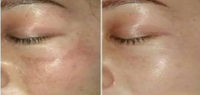 中國(guó)醫(yī)院雙眼皮修復(fù)技術(shù)，2023新晉熱門(mén)曝光！