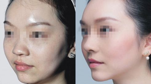 臺州哪家醫(yī)院治療乳頭矯正效果好？