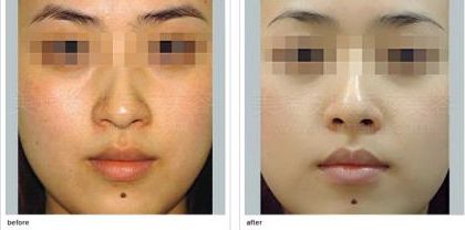 臺州狐臭治療中哪家醫(yī)院效果好？