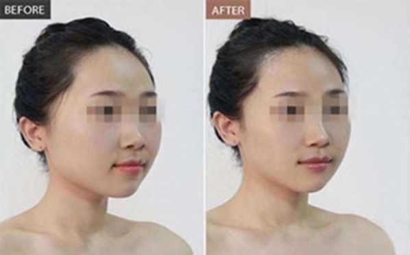 溫州哪家醫(yī)院做肋骨鼻手術好