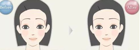 浙江哪家醫(yī)院眼袋祛除效果好？