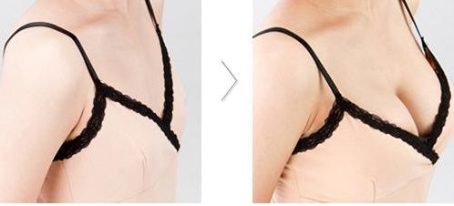 三明市第二醫(yī)院重磅推薦：陳國章醫(yī)生絕佳雙眼皮+內(nèi)眼角完美案例！