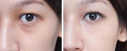 杭州藝星拉皮手術(shù)真的有效嗎？