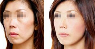 果酸祛痘間隔多久做一次？效果不明顯怎么辦？