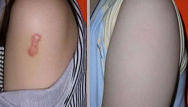 廣州天姿整形醫(yī)院，鼻部整形效果曝光，看看這次個案如何！