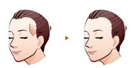 癌癥患者的雙眼皮手術(shù)費用分析及成功案例分享