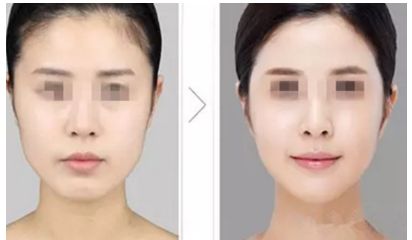 廣東哪家整形醫(yī)院醫(yī)師團(tuán)隊(duì)強(qiáng)大？筆者推薦廣東省人民醫(yī)院整形外科