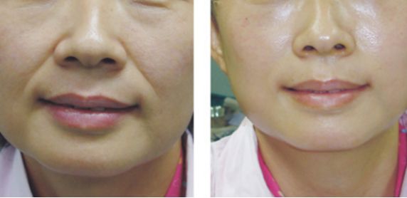 西安市綜合實力強勁的除皺拉皮醫(yī)院排行榜出爐！這六家信譽卓越，獨具醫(yī)療價值，價格明細附后