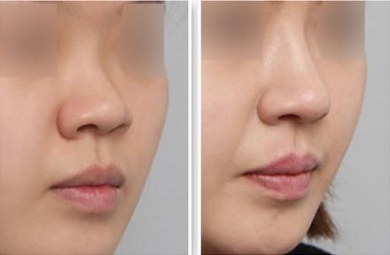 杭州最受歡迎的胸部整容整形醫(yī)院排行榜揭曉，網(wǎng)友推薦眾多醫(yī)院，有沒有熟悉的？