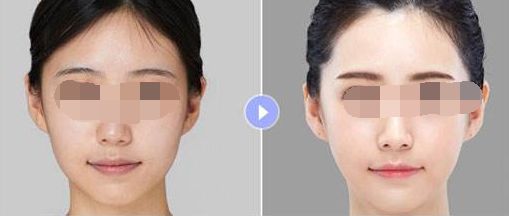 廣州哪家隆胸整形醫(yī)院好？排名大揭曉！