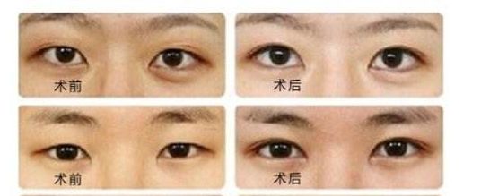 菲塑美減肥針：效果評估、價格和潛在風(fēng)險全解析