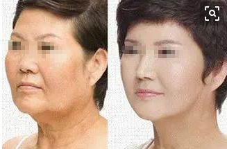 成都去痣名醫(yī)推薦，排行榜前五名有誰(shuí)？