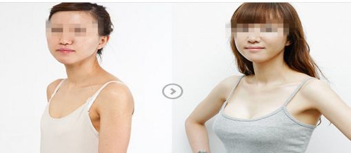 北京童仁醫(yī)院專(zhuān)家團(tuán)隊(duì)介紹及雙眼皮手術(shù)恢復(fù)過(guò)程詳解