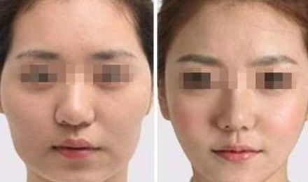 揭秘北京東方和諧脂肪填充真容，真實(shí)案例展示精湛技藝！