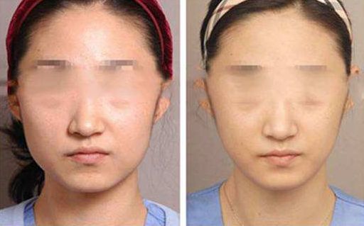 廣州下頜角手術(shù)哪家醫(yī)院比較靠譜？