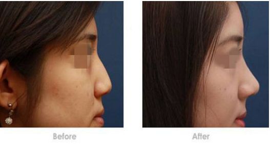 烏魯木齊最受歡迎的脂肪填充整形機構(gòu)推薦