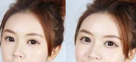 注射伊維蘭隆鼻，多久恢復消腫效果好？