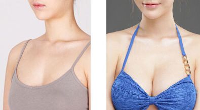 大連李爽矯治專家：隱形矯治、金屬托槽哪家好！