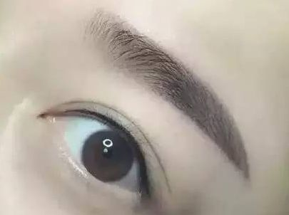 蘇州圣愛醫(yī)院整形科：90天變化揭示，雙眼皮驚喜盡顯！