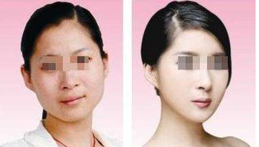 大連附屬二院美容科恢復(fù)效果實(shí)拍，價格揭秘