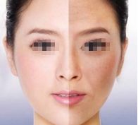 劉志剛醫(yī)生雙眼皮手術(shù)效果怎么樣？