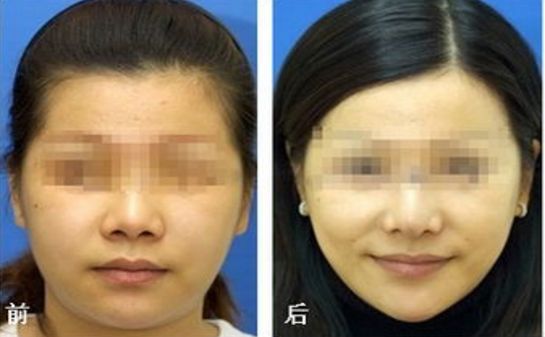 銀川哪家醫(yī)院磨骨整形效果好？