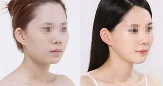 石家莊哪家整形醫(yī)院在隆鼻方面有口碑？