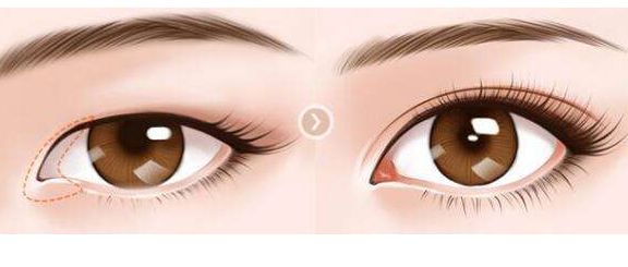 肖海濤的雙眼皮割成效如何？獨特技術吸引圈粉！