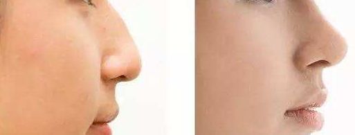 【2023】成都八大處田孝臣隆鼻案例揭秘，鼻部改善效果大躍進(jìn)！