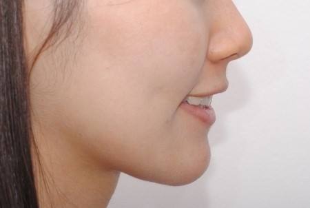 溫醫(yī)大附二院整形科鼻綜合修復(fù)效果可信賴嗎？徐海艇醫(yī)生的豐富經(jīng)驗是否值得信賴呢？