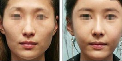 成都最佳雙眼皮修復(fù)醫(yī)院推薦，信譽(yù)口碑好的五家專業(yè)機(jī)構(gòu)