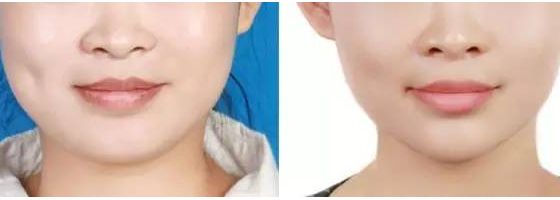 吉林梁一國(guó)醫(yī)生為您呈現(xiàn)神奇雙眼皮手術(shù)！2023親身經(jīng)歷分享