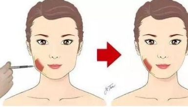 高效祛除眼袋的空軍醫(yī)院腫眼泡治療，看看效果如何？