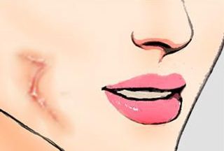 三亞心夢(mèng)醫(yī)學(xué)劉濤醫(yī)生揭秘，無(wú)創(chuàng)吸脂實(shí)踐案例分享及收費(fèi)解析！