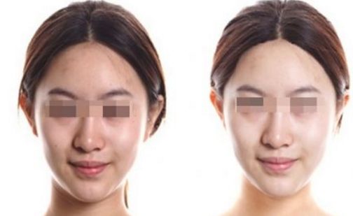 武漢皮膚科祛斑治療效果好在哪？名醫(yī)推薦+祛斑真實案例分享