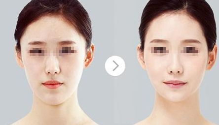 鄭州哪家醫(yī)院比較好做唇部整形？