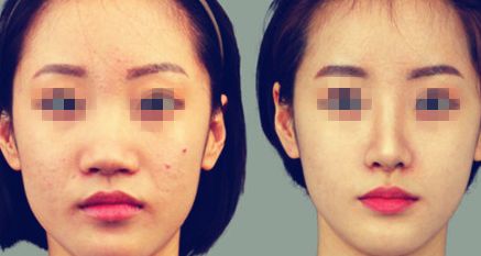 西安哪家醫(yī)院可以做隆胸手術