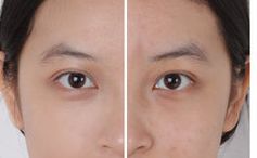 北京301醫(yī)院祛除眼袋方法揭秘，2023真實(shí)案例曝光！