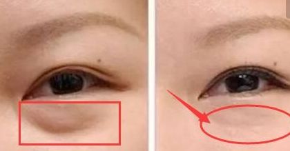 上海楊亞益雙眼皮修復(fù)技術(shù)解析，案例分享全文解讀